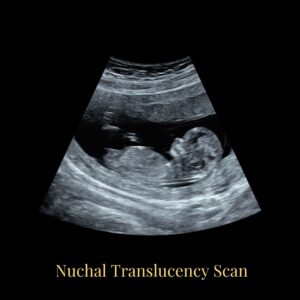 increased nuchal translucency ultrasound in