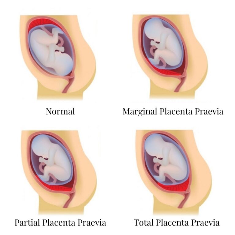 Placental position